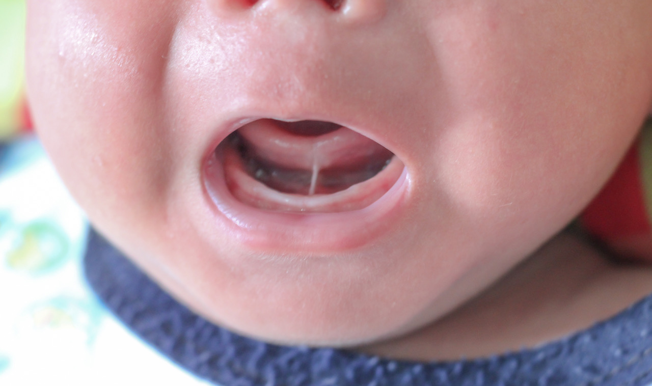 Child Tongue Tie Division Paediatric Gut Investigation Clinic
